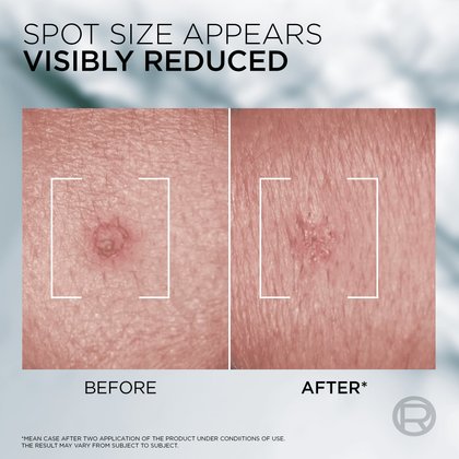 6 Derma Control Pimple Paste Before And After Shot