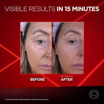 EYE BAG RESULTS 1